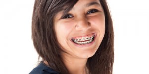 orthodontia-dental-full-coverage